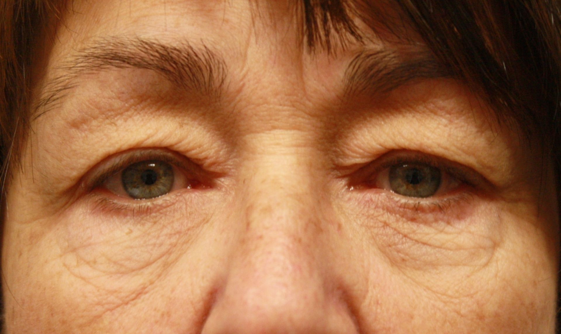 Chirurgie des 4 paupières