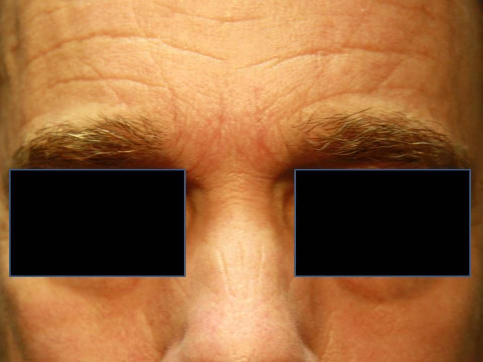 Agents de comblement