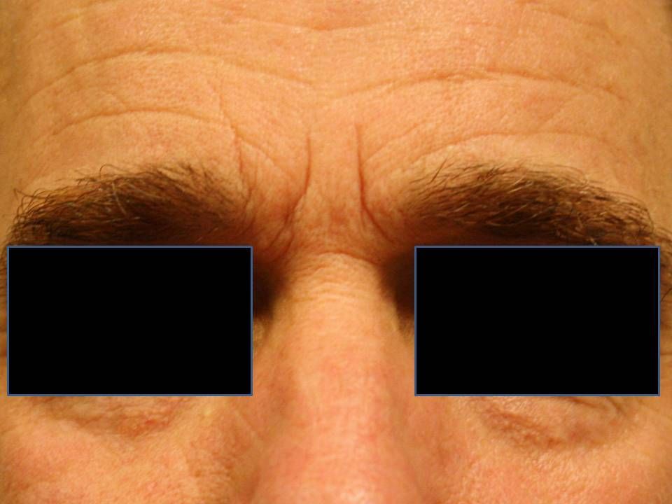 Agents de comblement