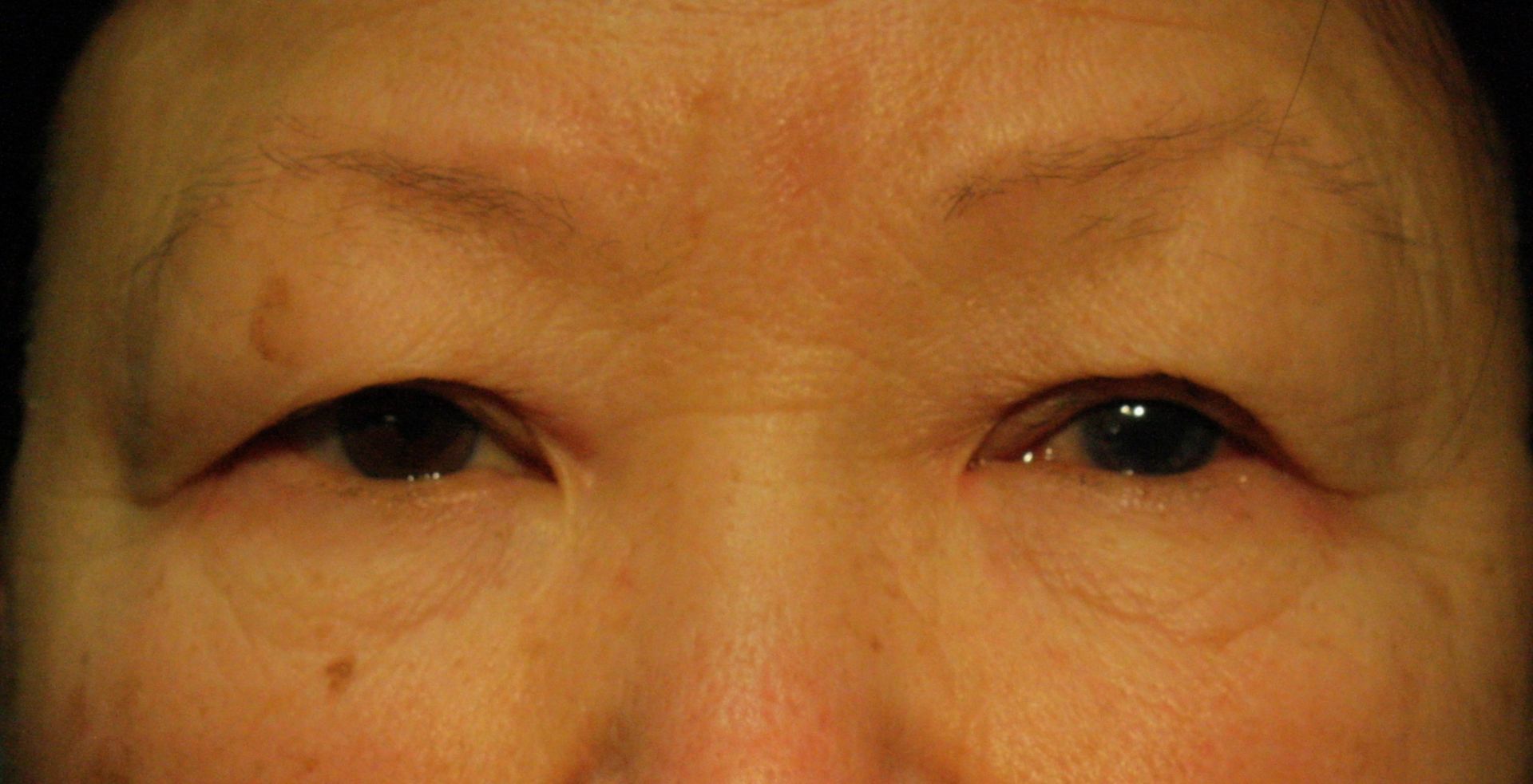 Correction de la ptose