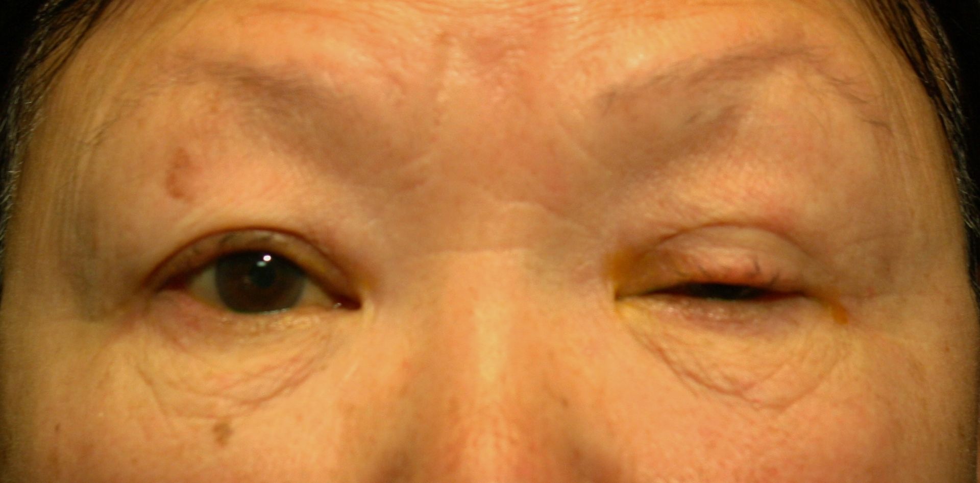 Correction de la ptose