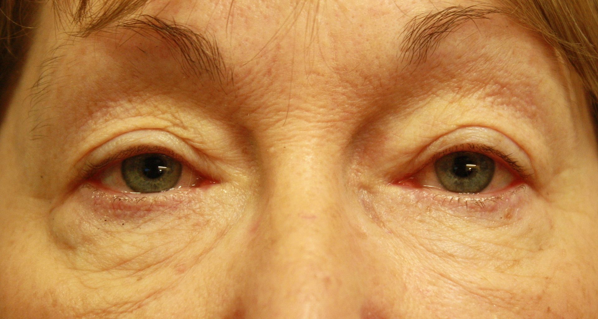 Correction de la ptose