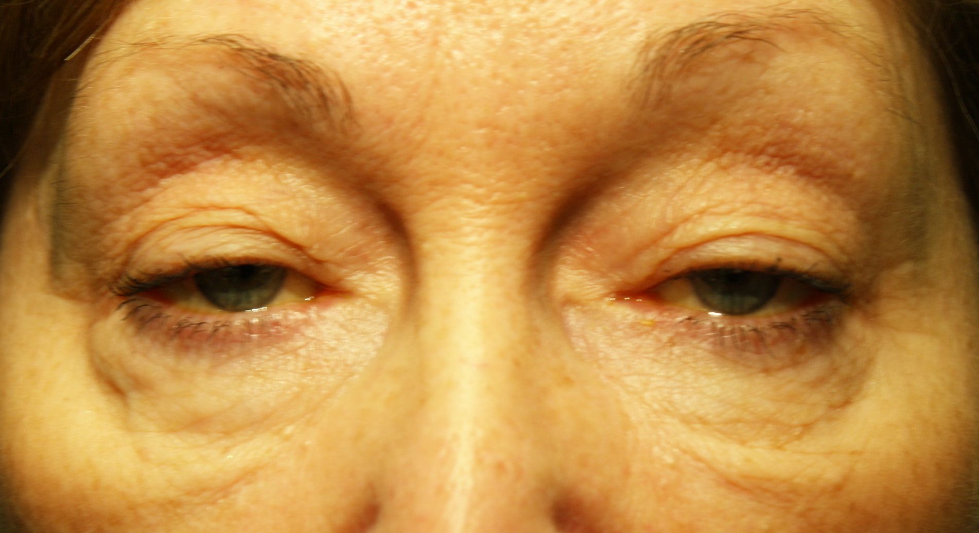 Correction de la ptose