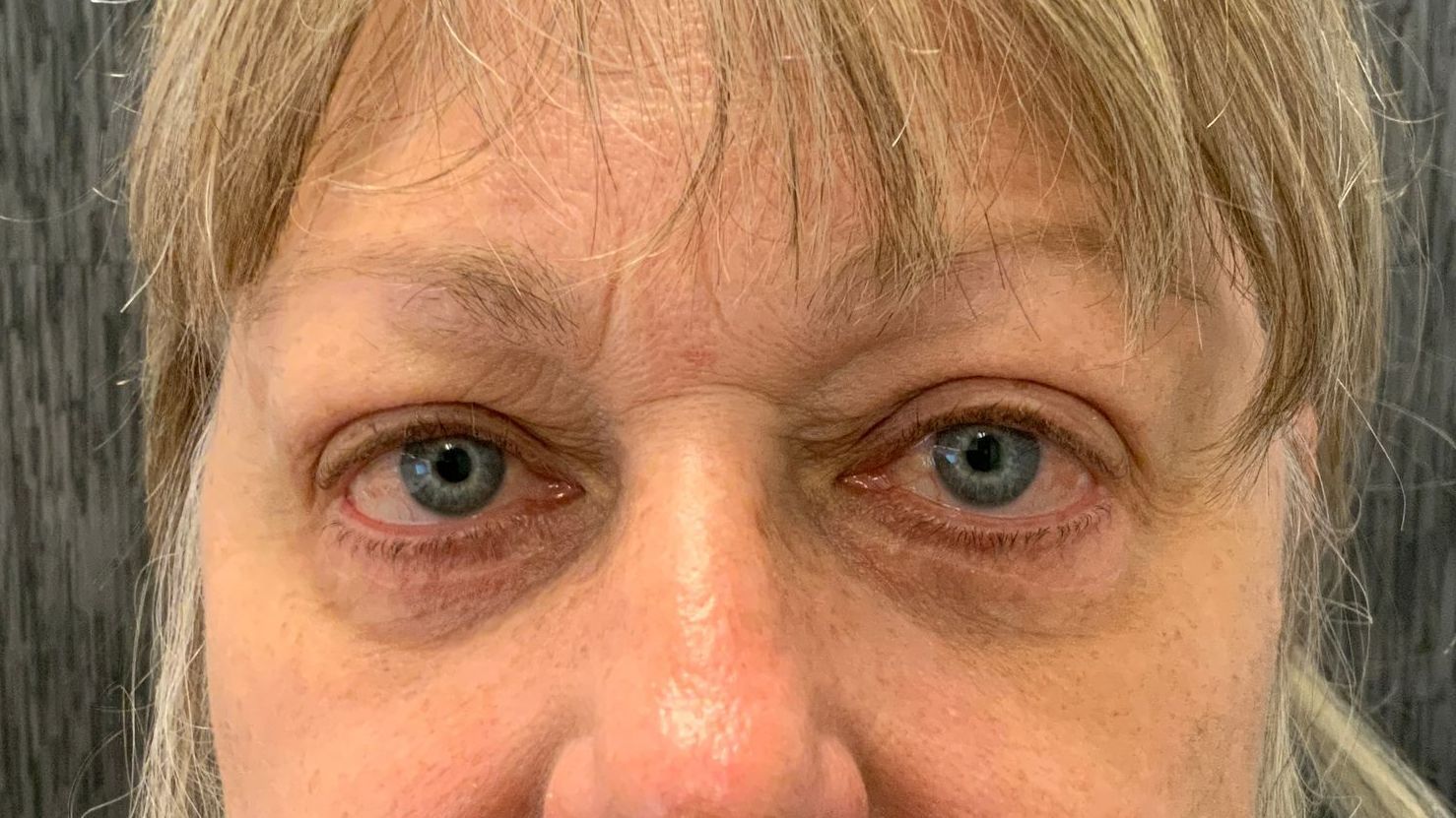 Chirurgie des 4 paupières