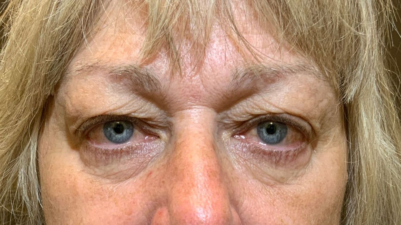 Chirurgie des 4 paupières