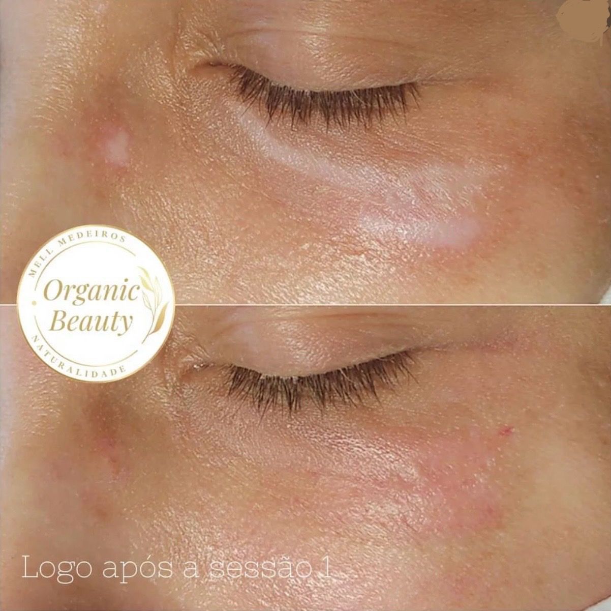 Camouflage de cicatrice- Melissa Medeiros - Mell Medeiros