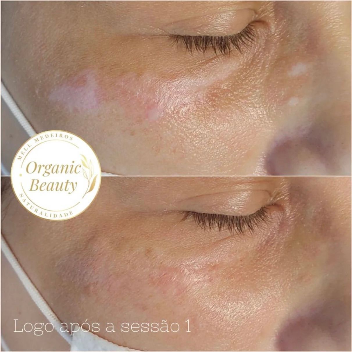 Camouflage de cicatrice- Melissa Medeiros - Mell Medeiros