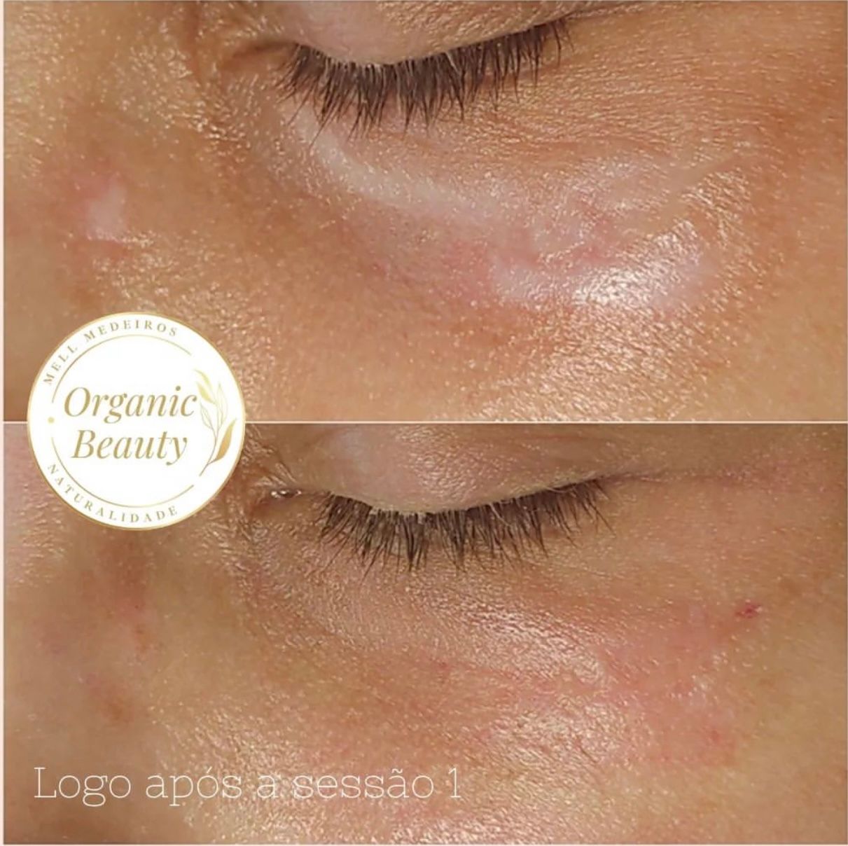 Camouflage de cicatrice- Melissa Medeiros - Mell Medeiros