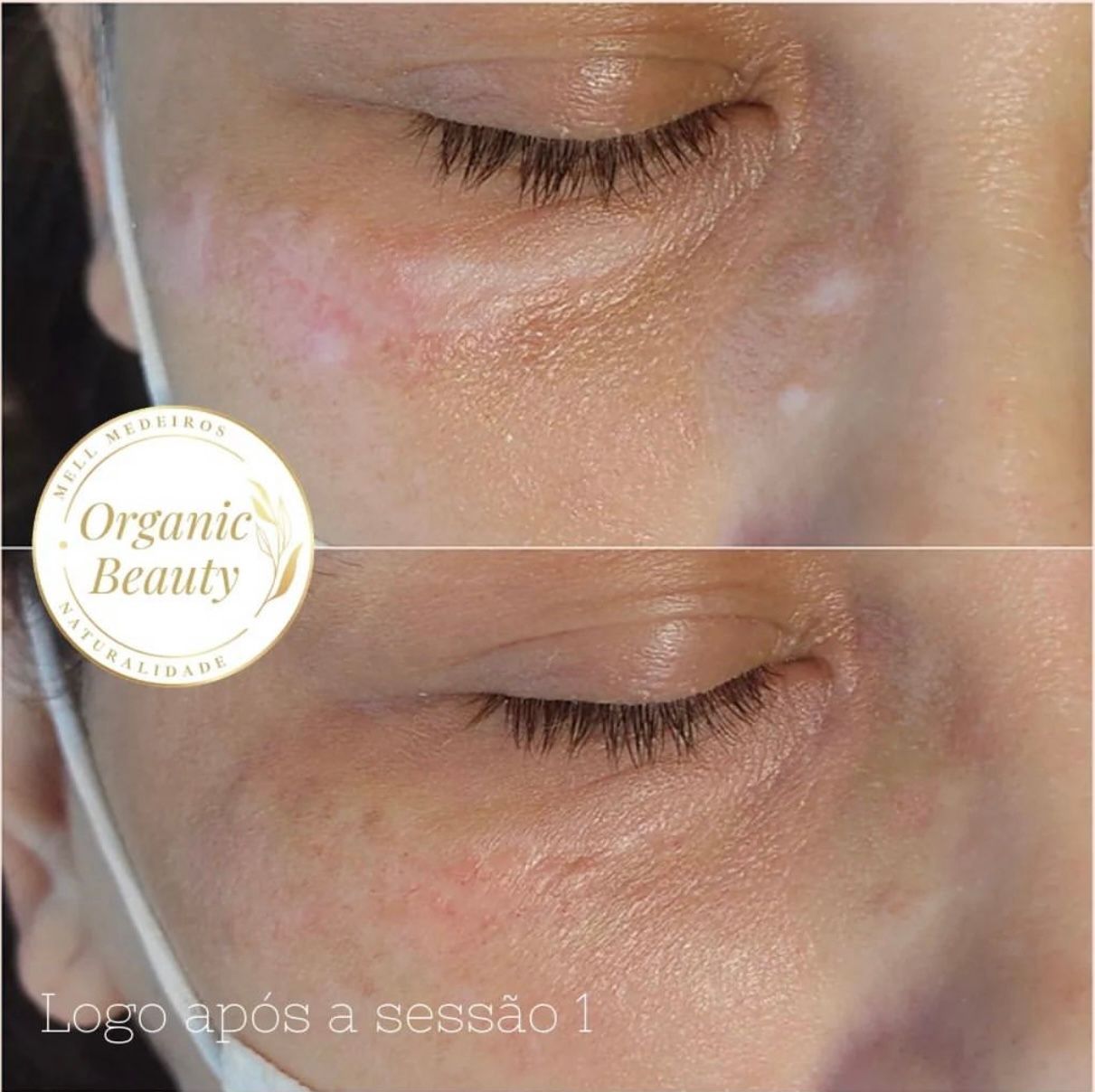 Camouflage de cicatrice- Melissa Medeiros - Mell Medeiros