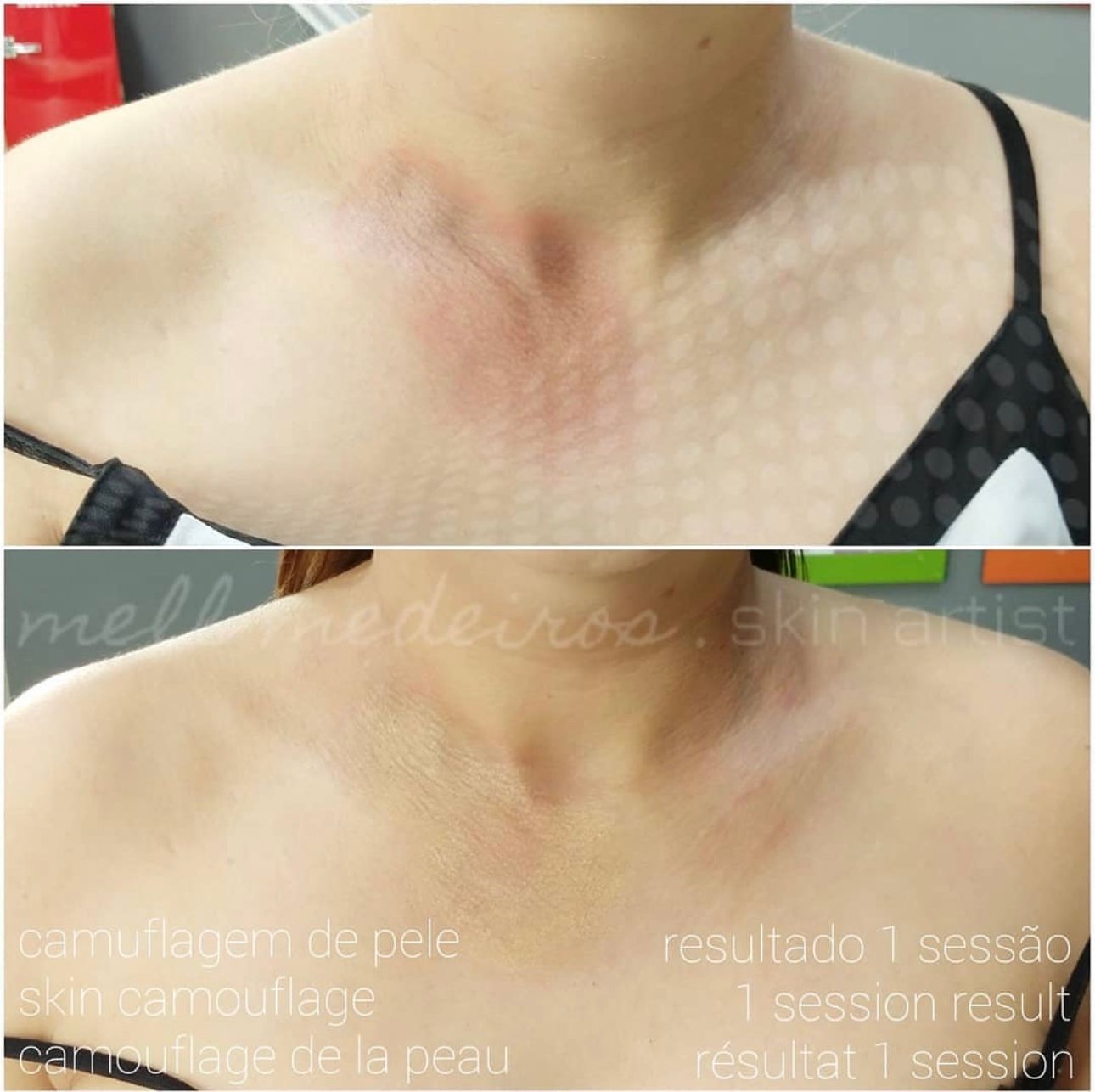 Camouflage de cicatrice - Melissa Medeiros - Mell Medeiros