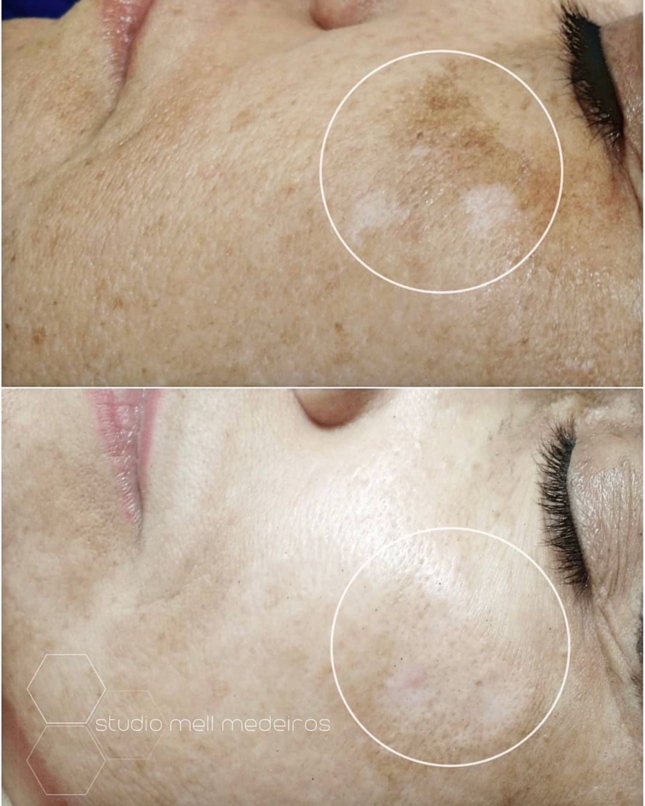 Camouflage de la peau - Melissa Medeiros - Mell Medeiros