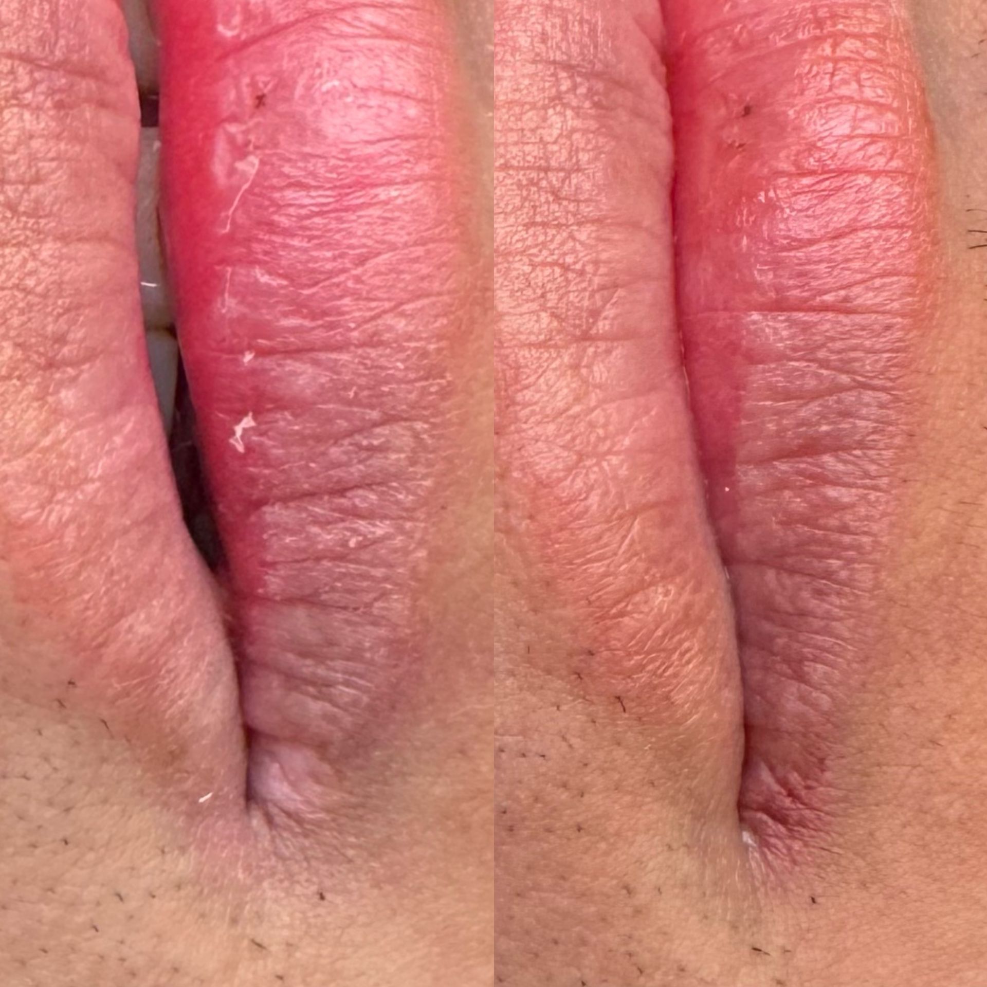 Camouflage de cicatrice - Melissa Medeiros - Mell Medeiros