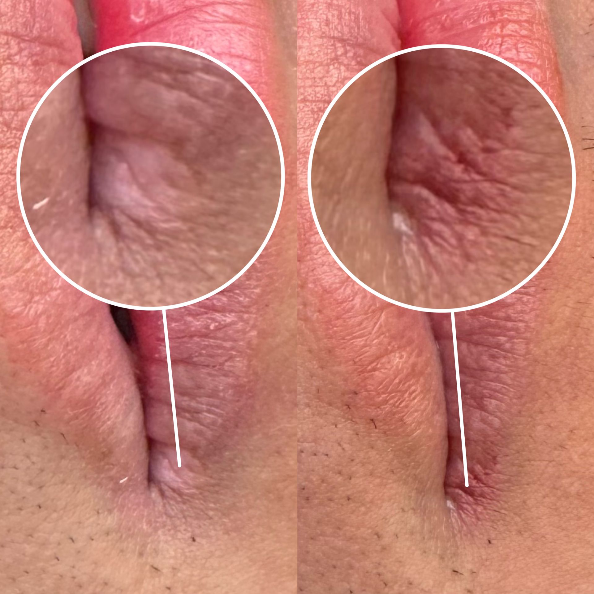 Camouflage de cicatrice - Melissa Medeiros - Mell Medeiros