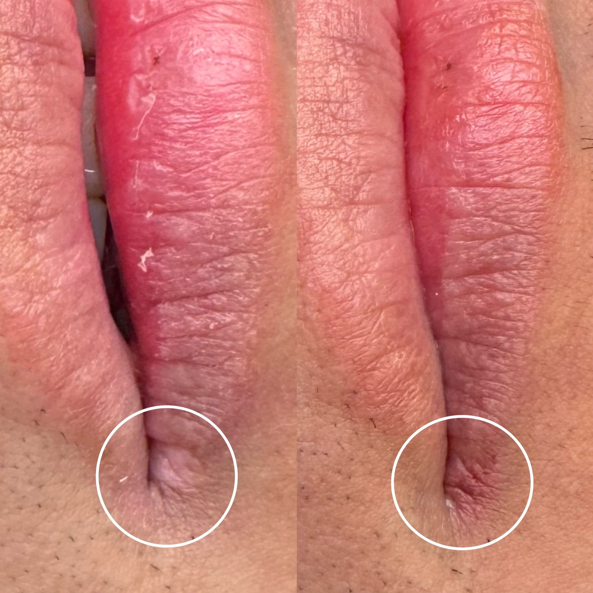 Camouflage de cicatrice - Melissa Medeiros - Mell Medeiros