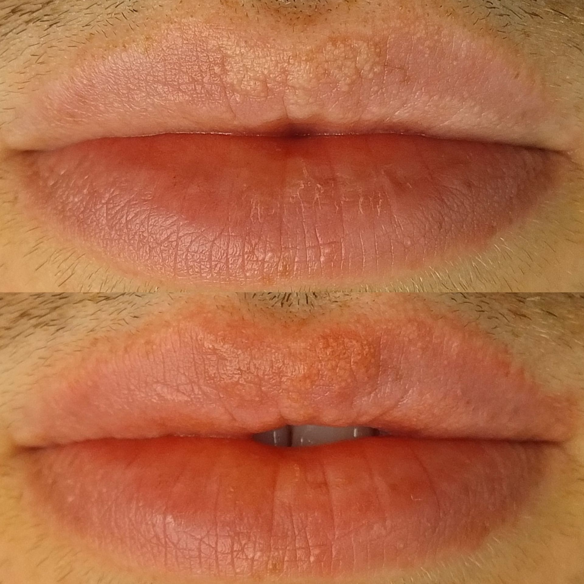 Pigmentation des grains de Fordyce - Melissa Medeiros - Mell Medeiros