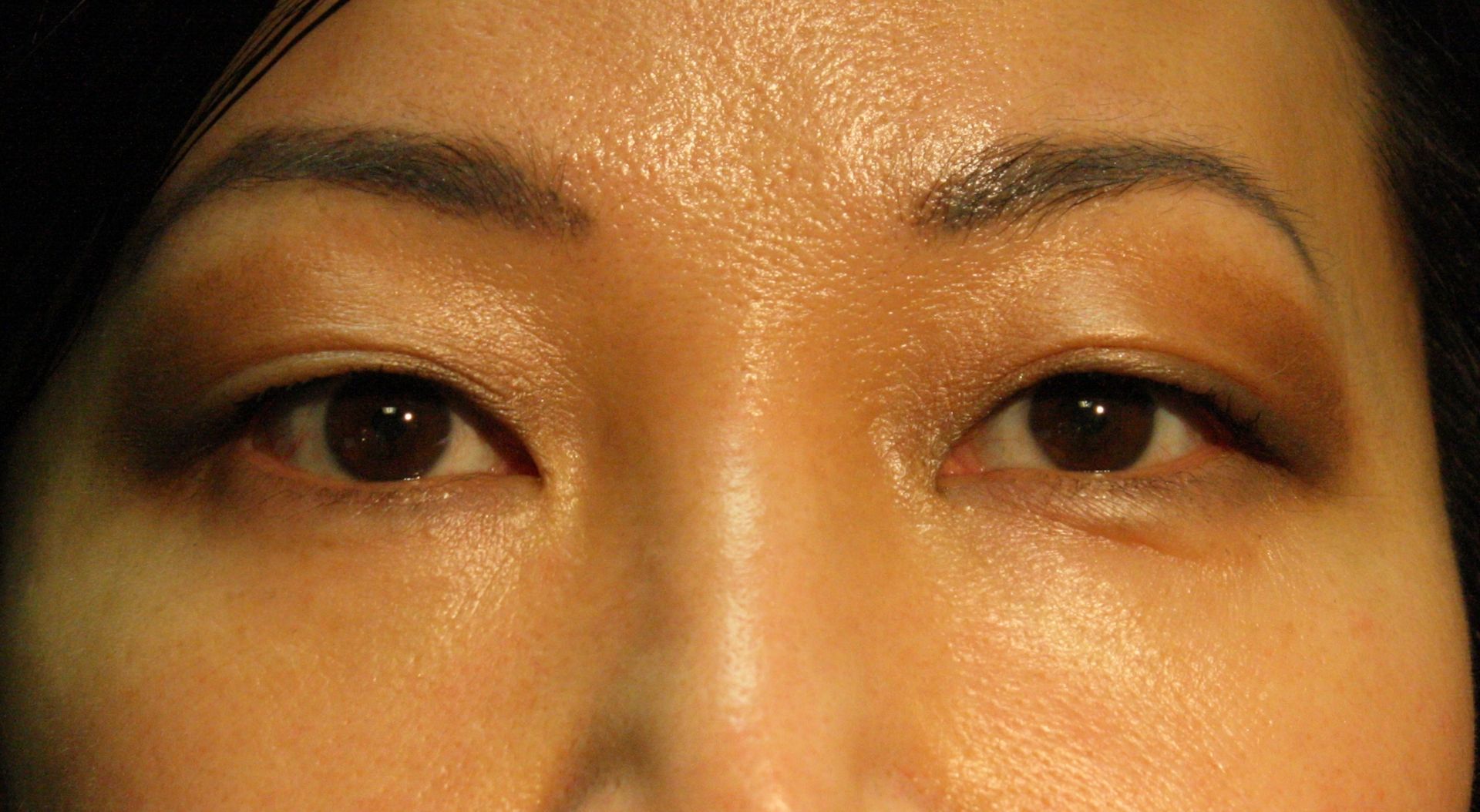 Chirurgie des paupieres asiatiques