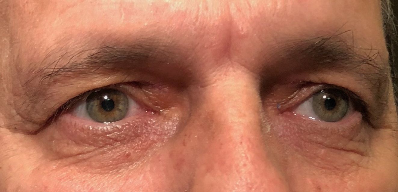 Xanthelasma
