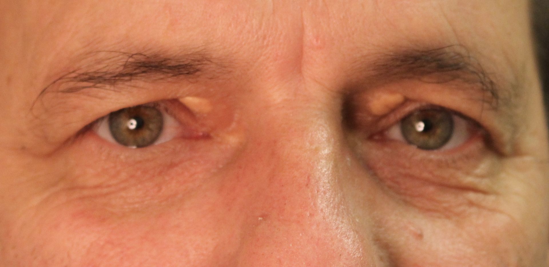 Xanthelasma