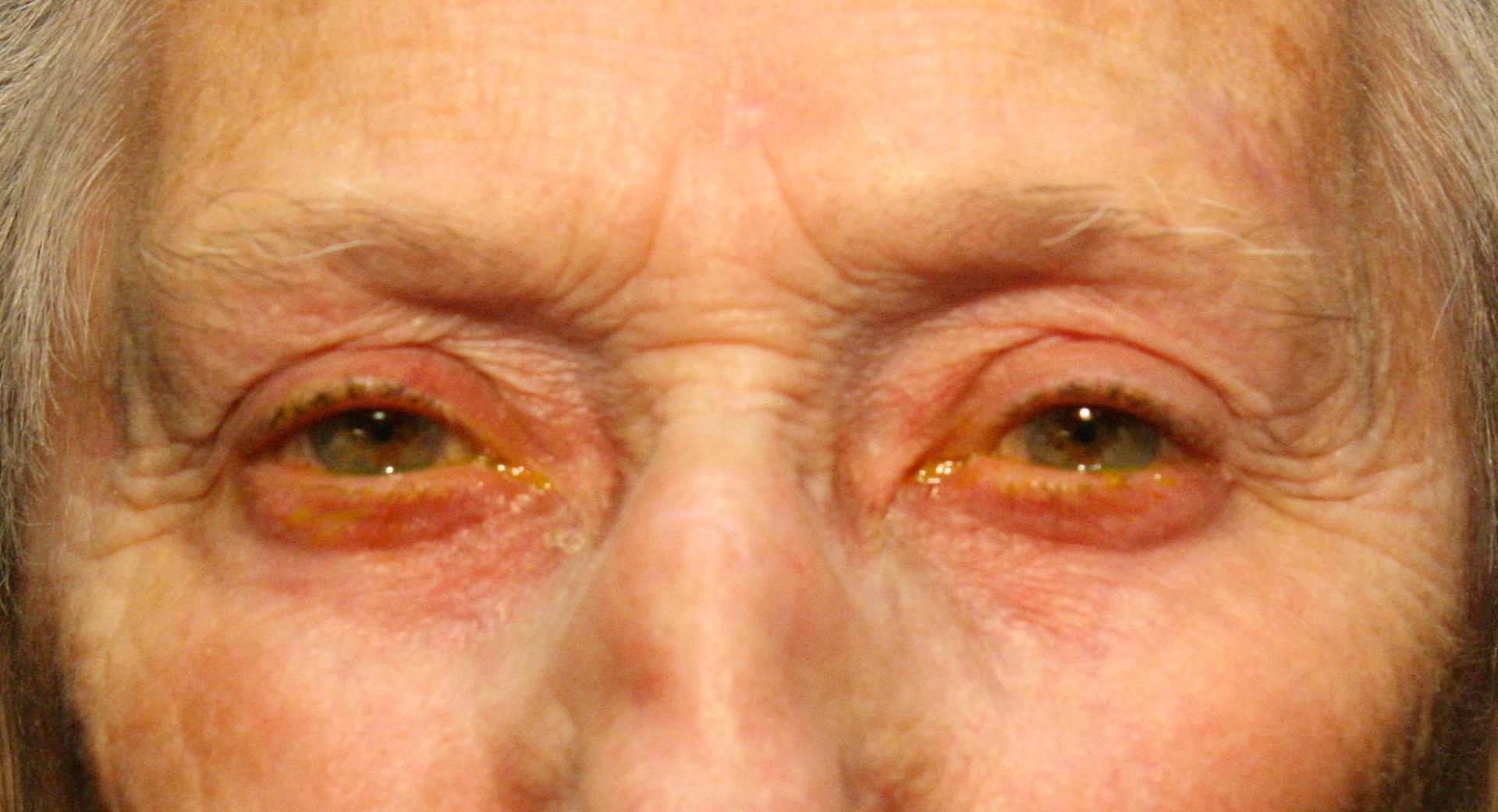 Correction de la ptose