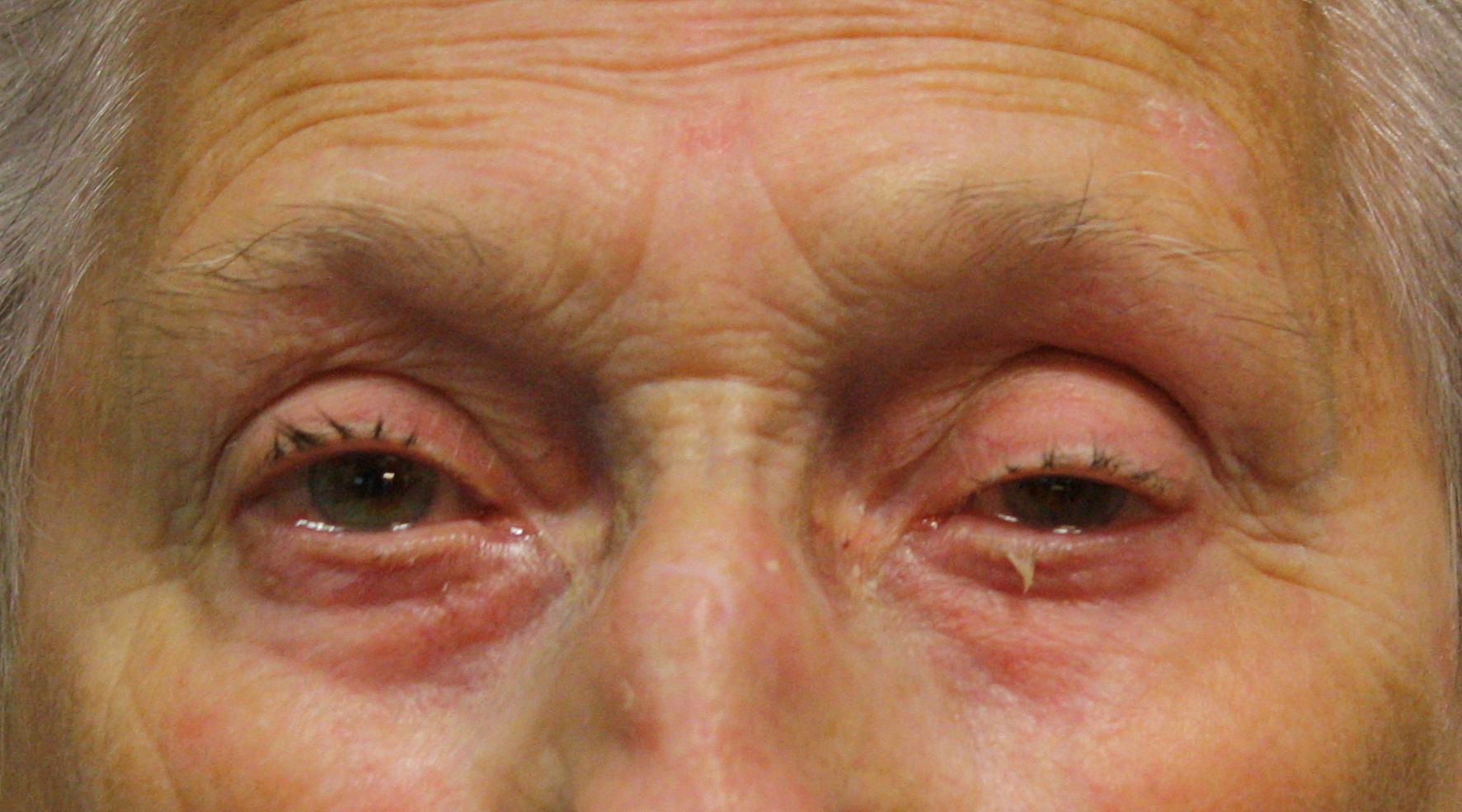 Correction de la ptose