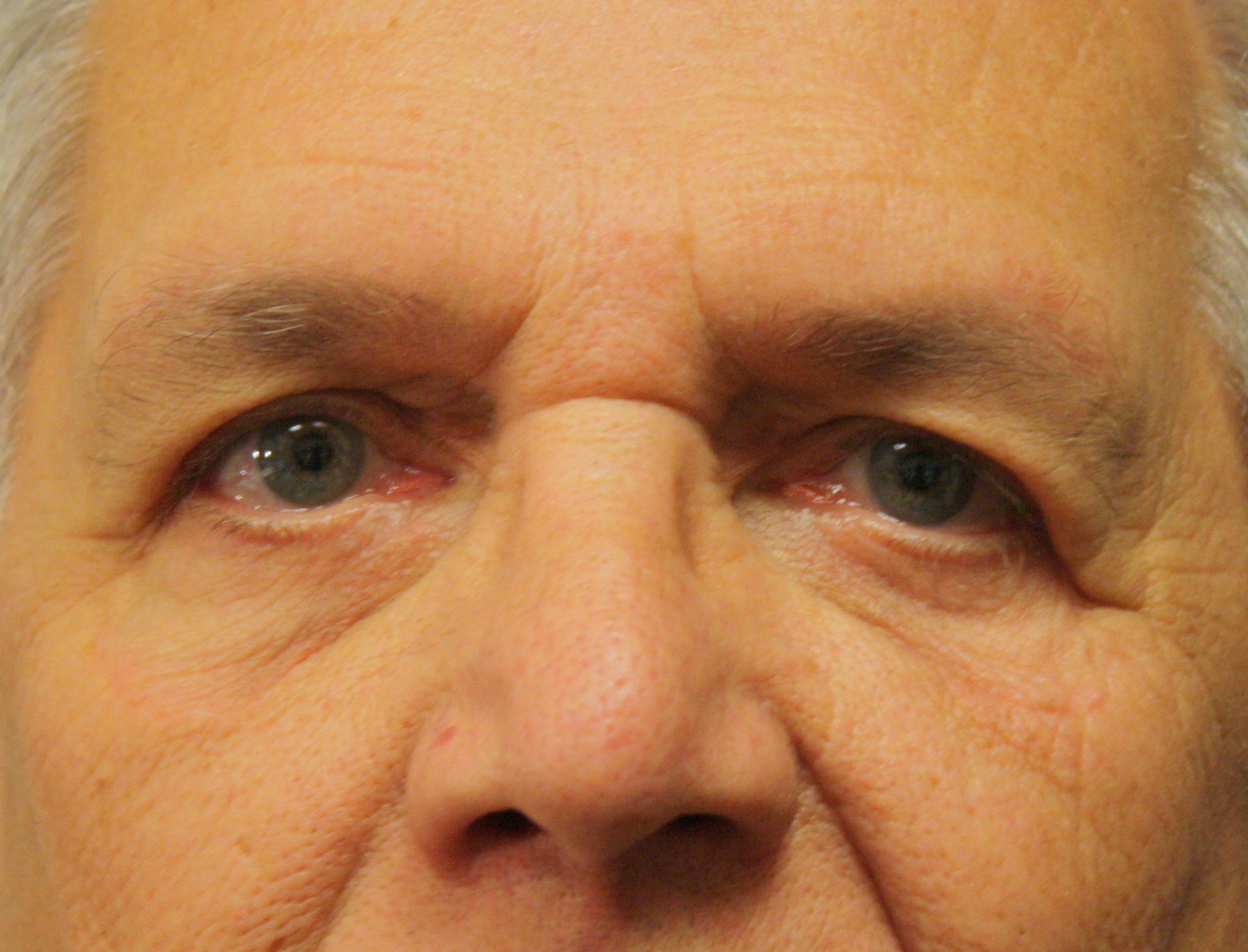 Chirurgie des paupieres inferieures