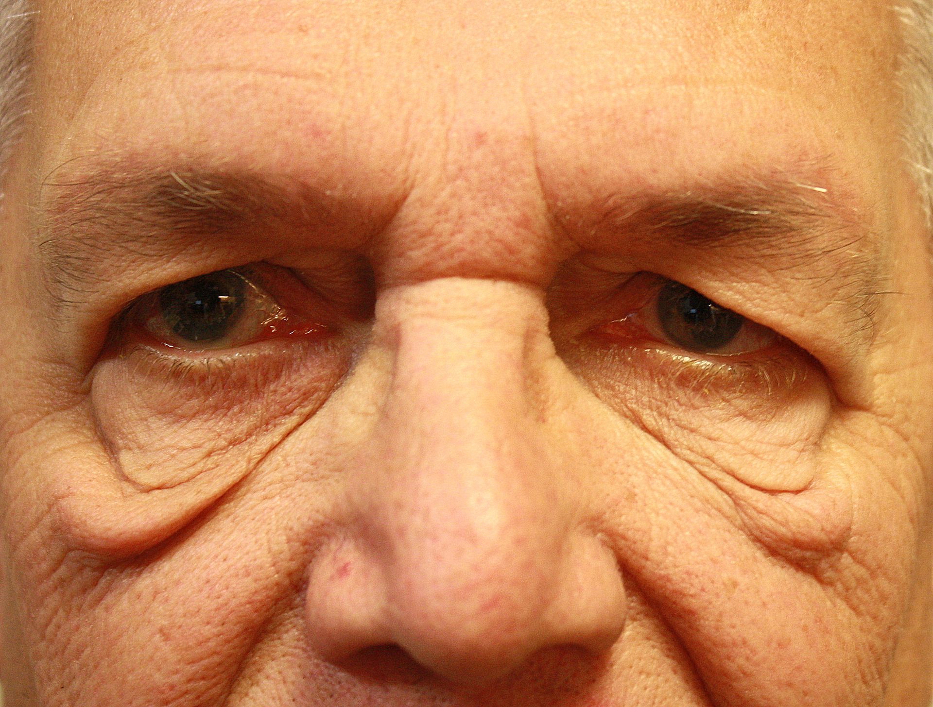 Chirurgie des paupieres inferieures