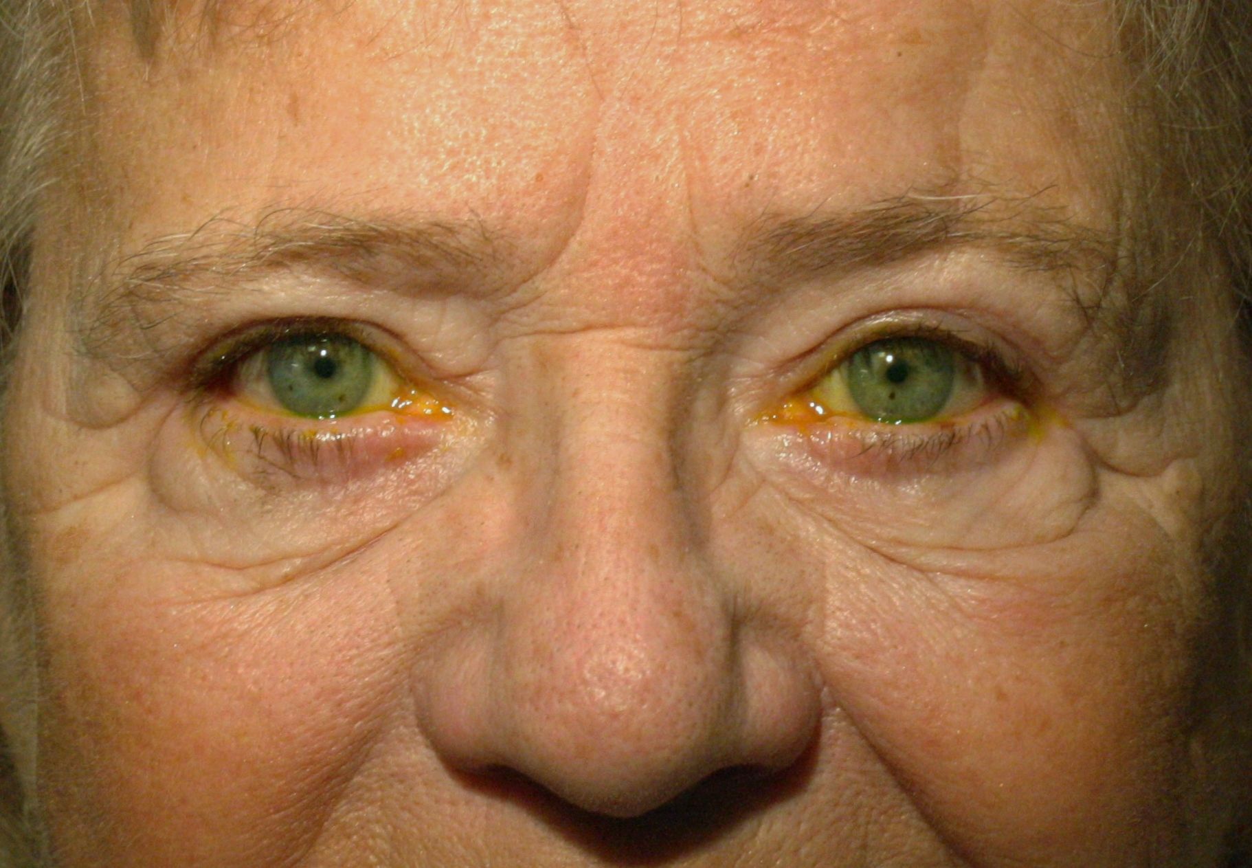 Chirurgie des paupières supérieures