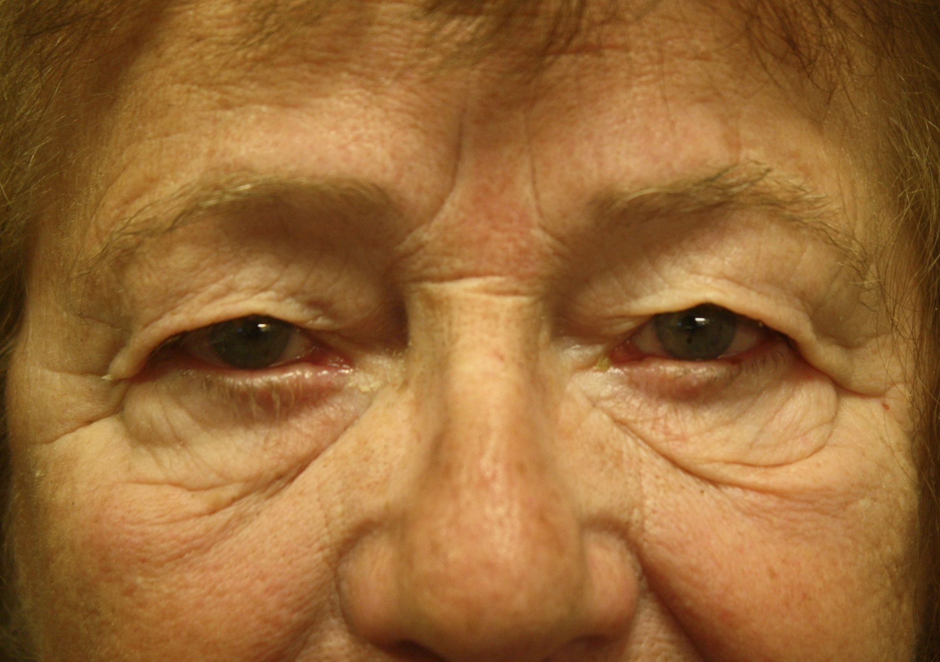 Chirurgie des paupières supérieures