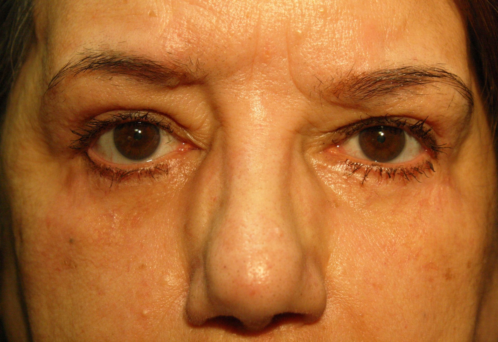 Chirurgie des 4 paupières