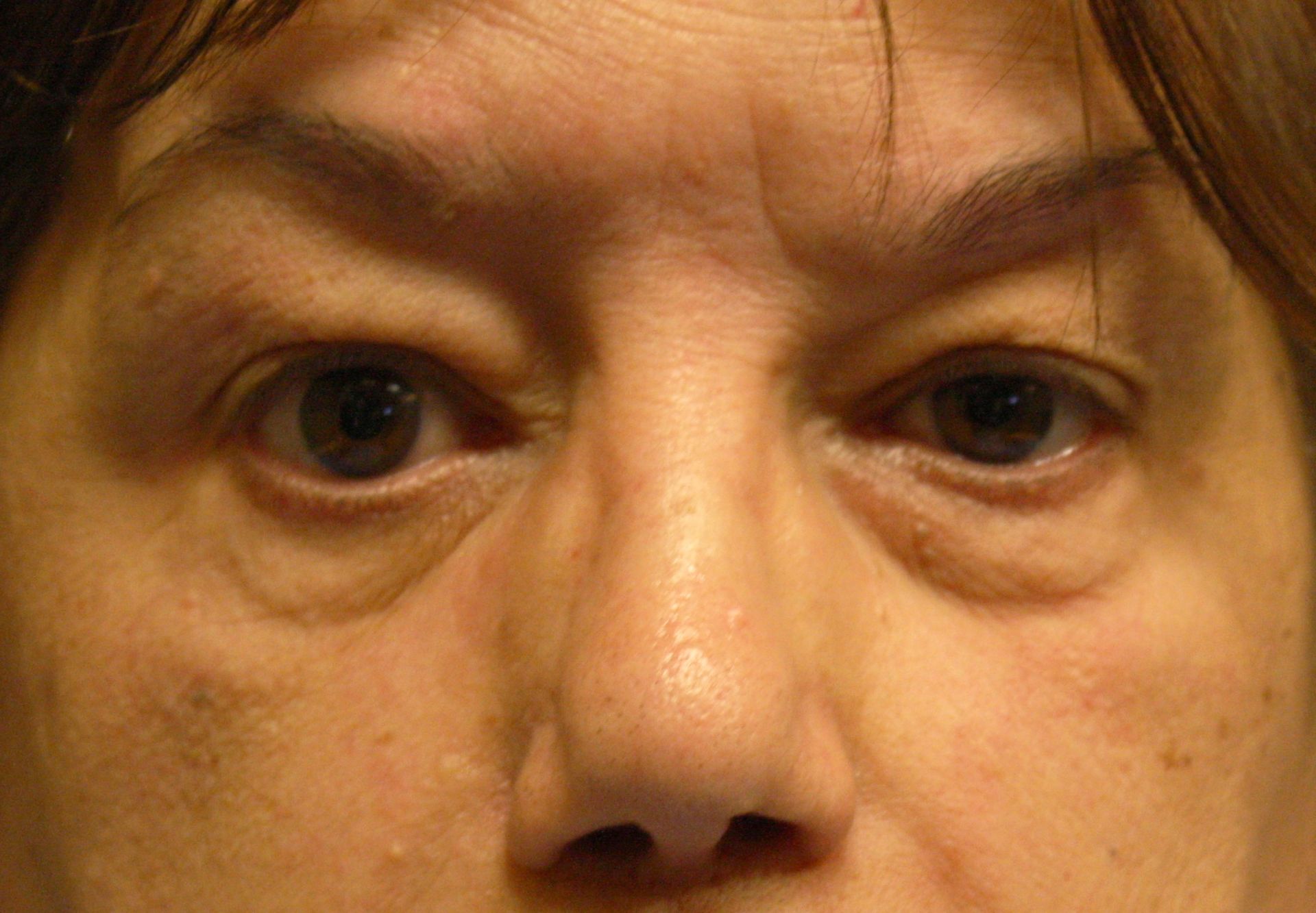 Chirurgie des 4 paupières