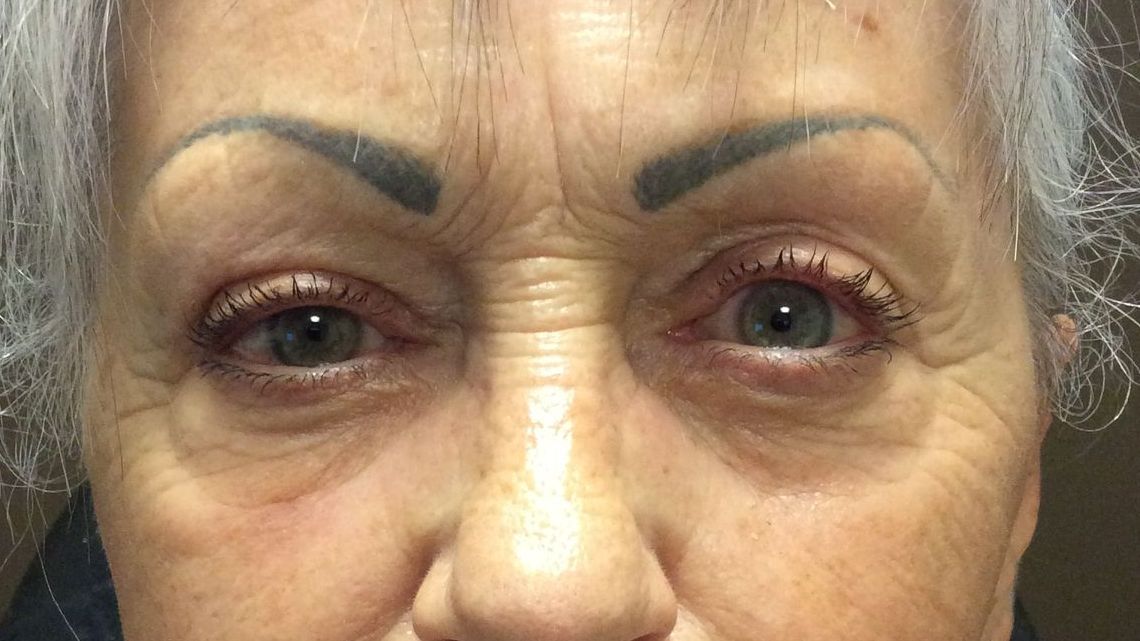 Chirurgie des paupières supérieures