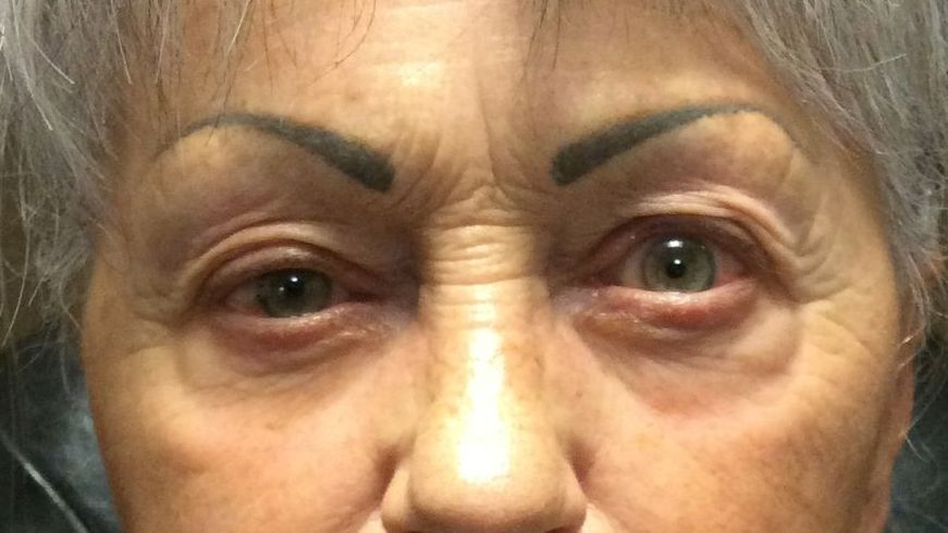 Chirurgie des paupières supérieures