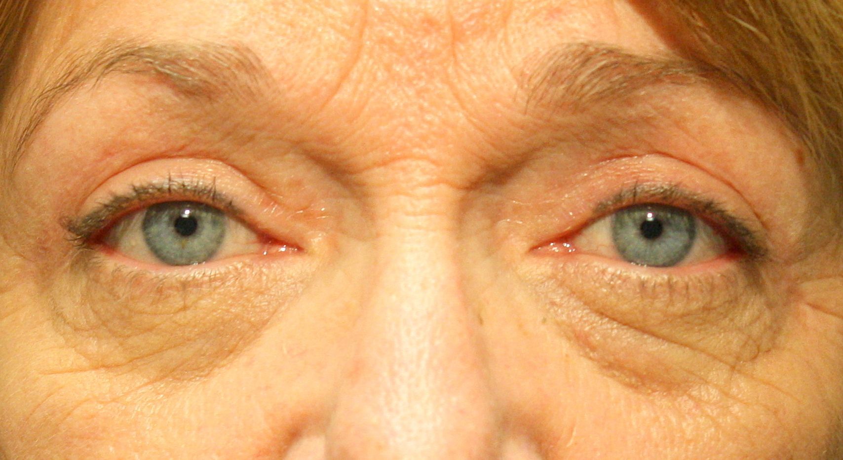 Chirurgie des paupières supérieures