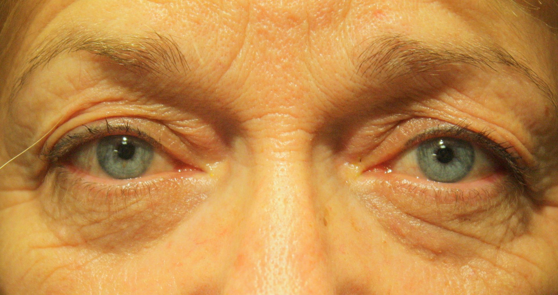 Chirurgie des paupières supérieures