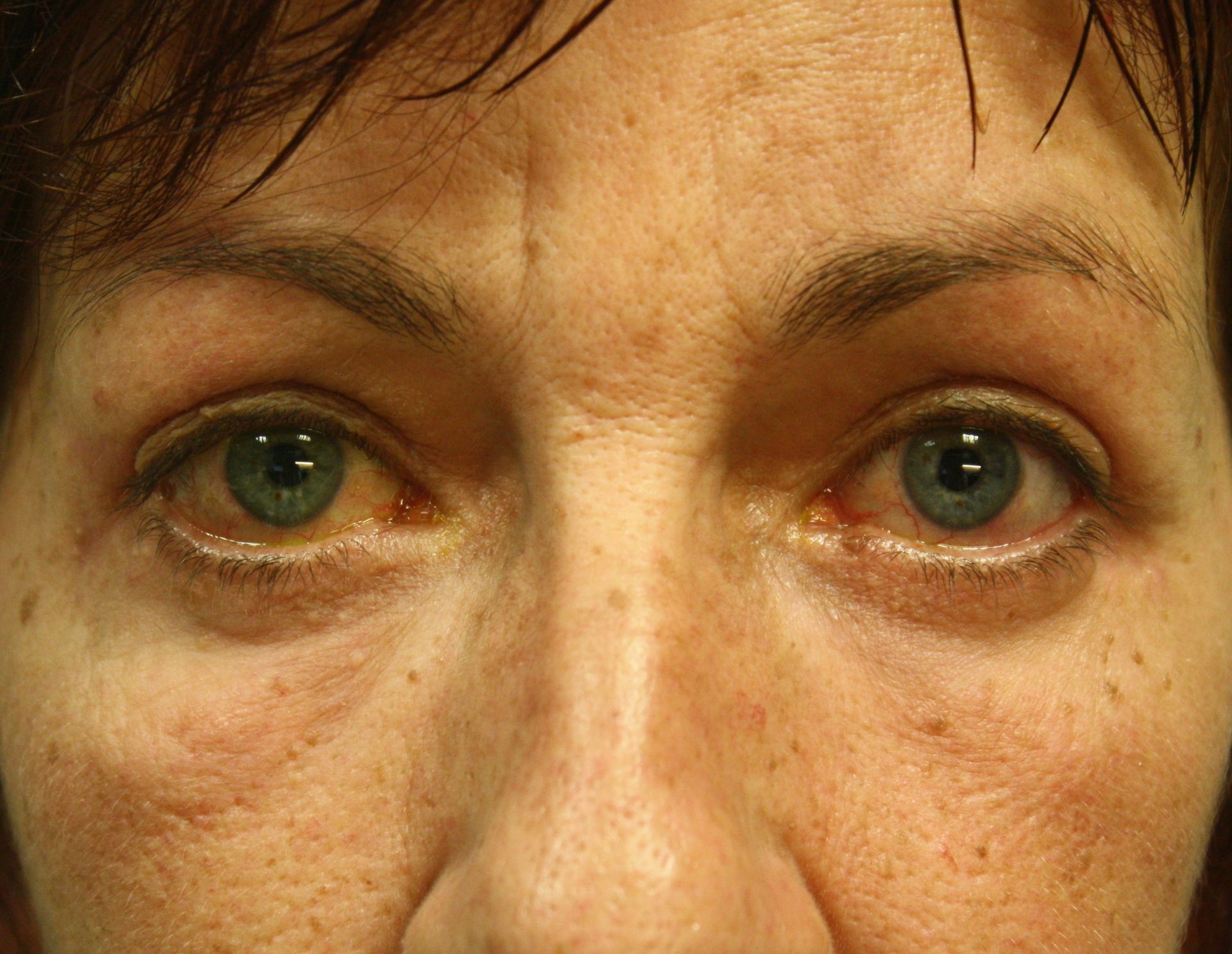 Chirurgie des 4 paupières