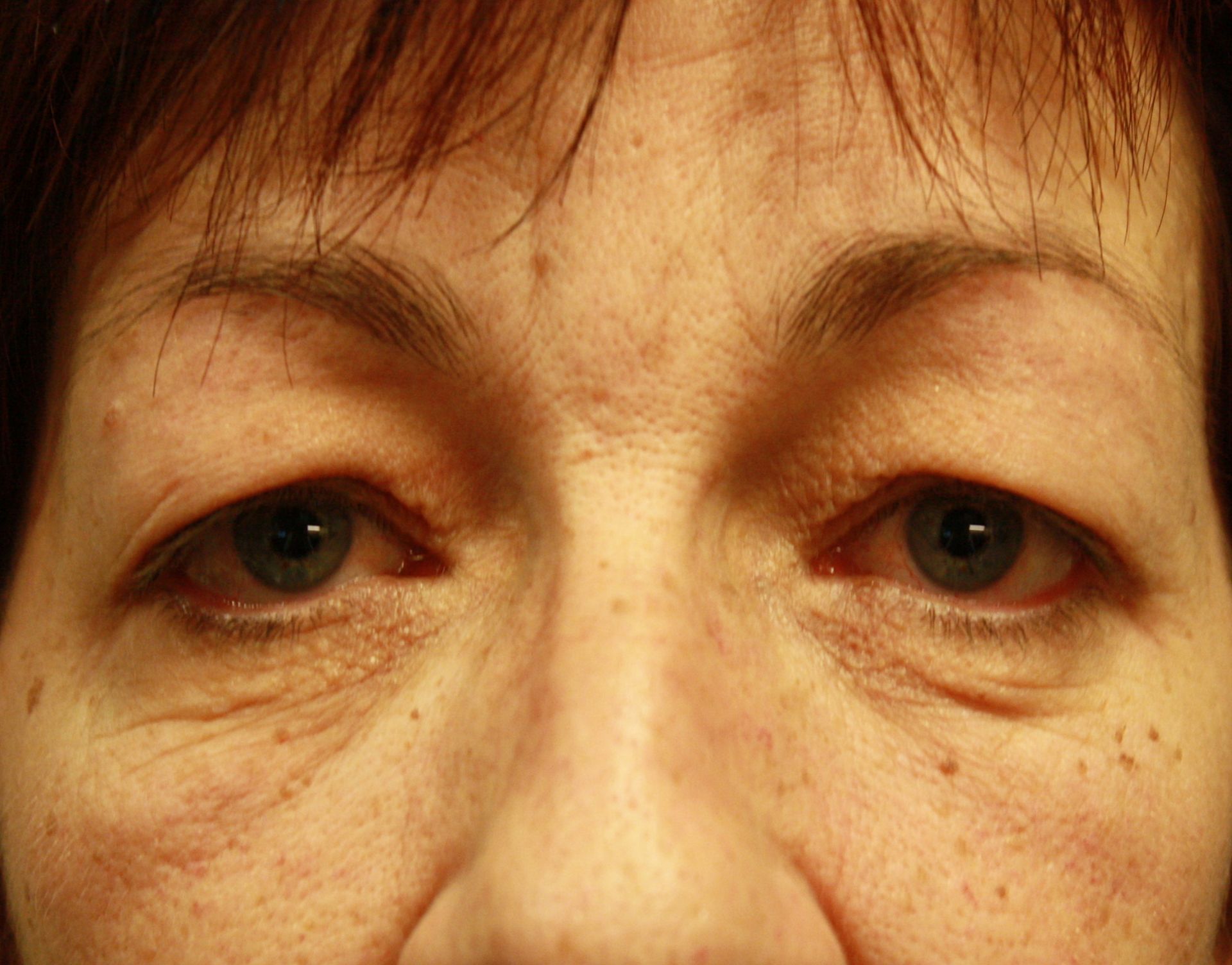 Chirurgie des 4 paupières