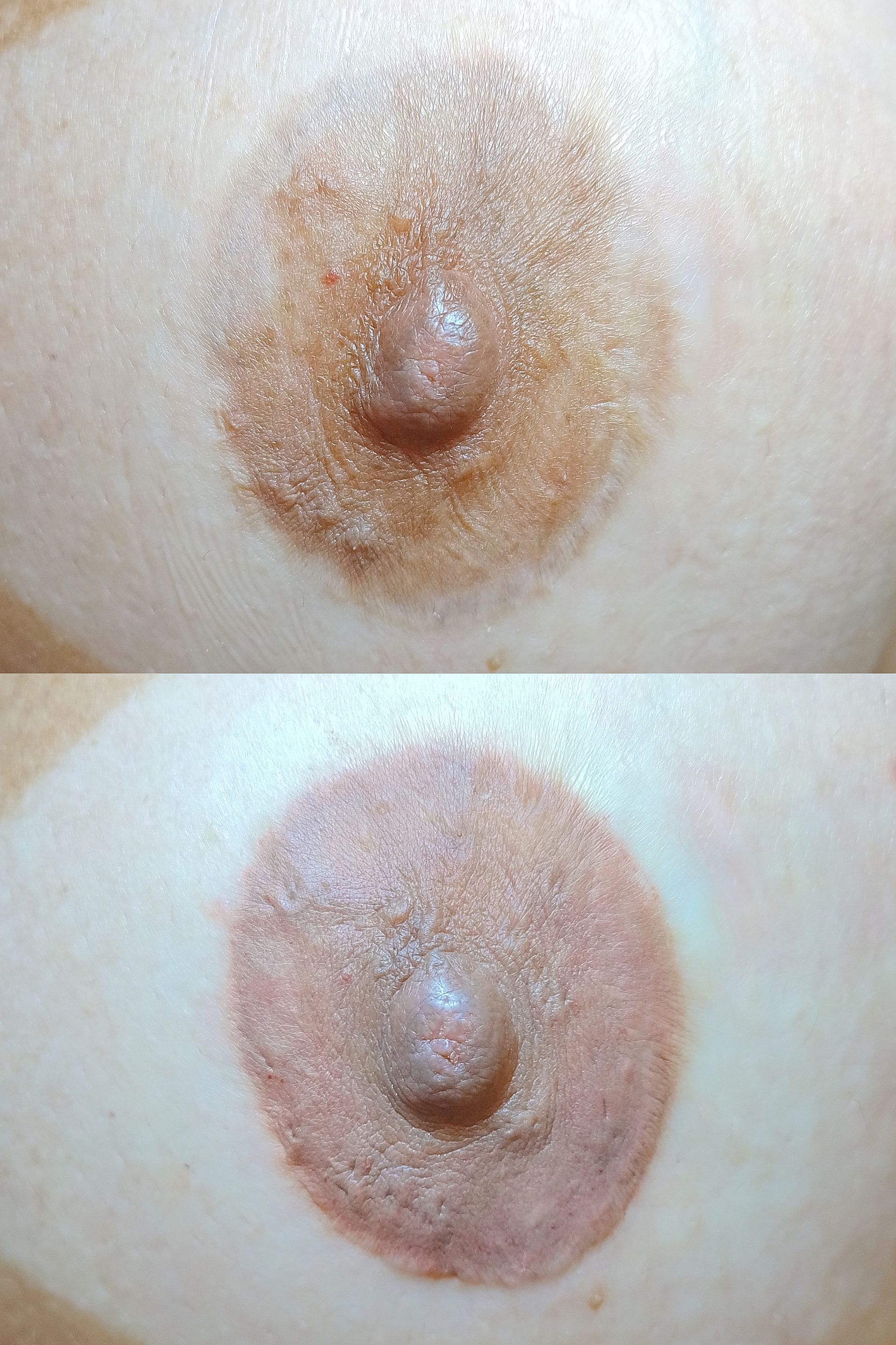 Reconstruction des Aréoles - Melissa Medeiros - Mell Medeiros