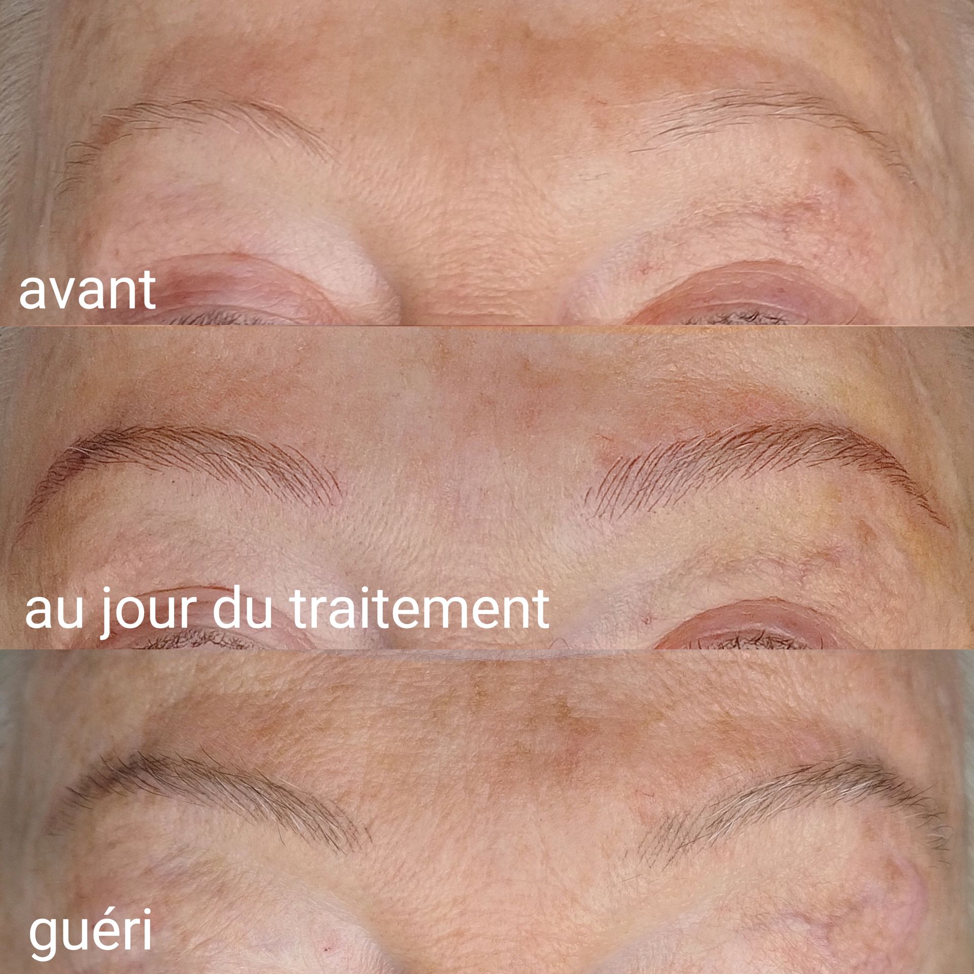 Microblading
