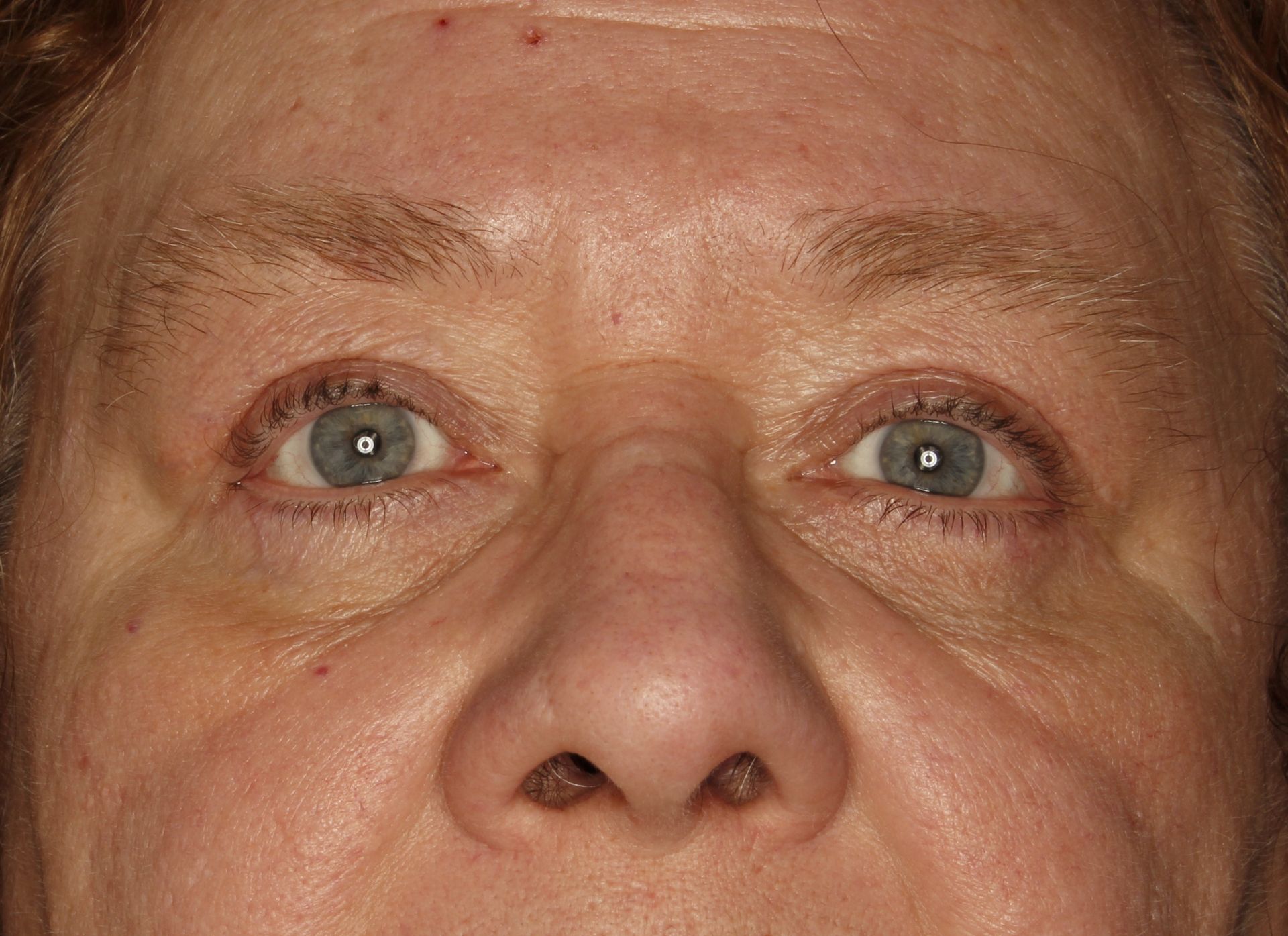 Chirurgie des 4 paupières