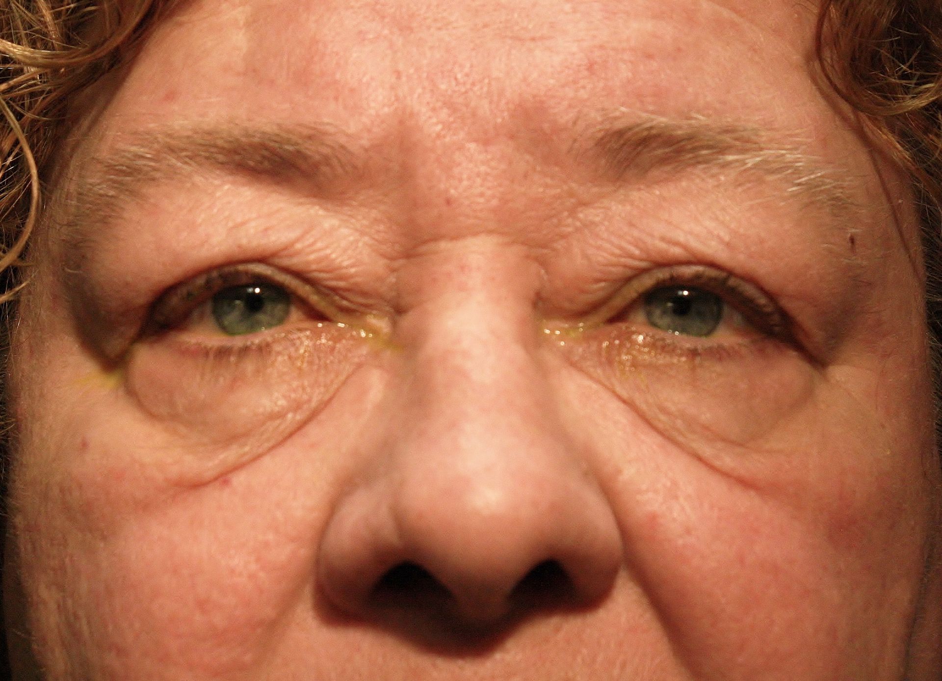 Chirurgie des 4 paupières