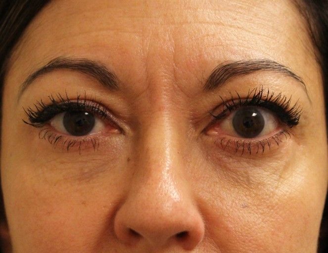 Chirurgie des paupieres inferieures