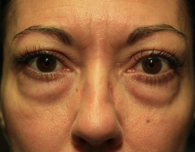 Chirurgie des paupieres inferieures