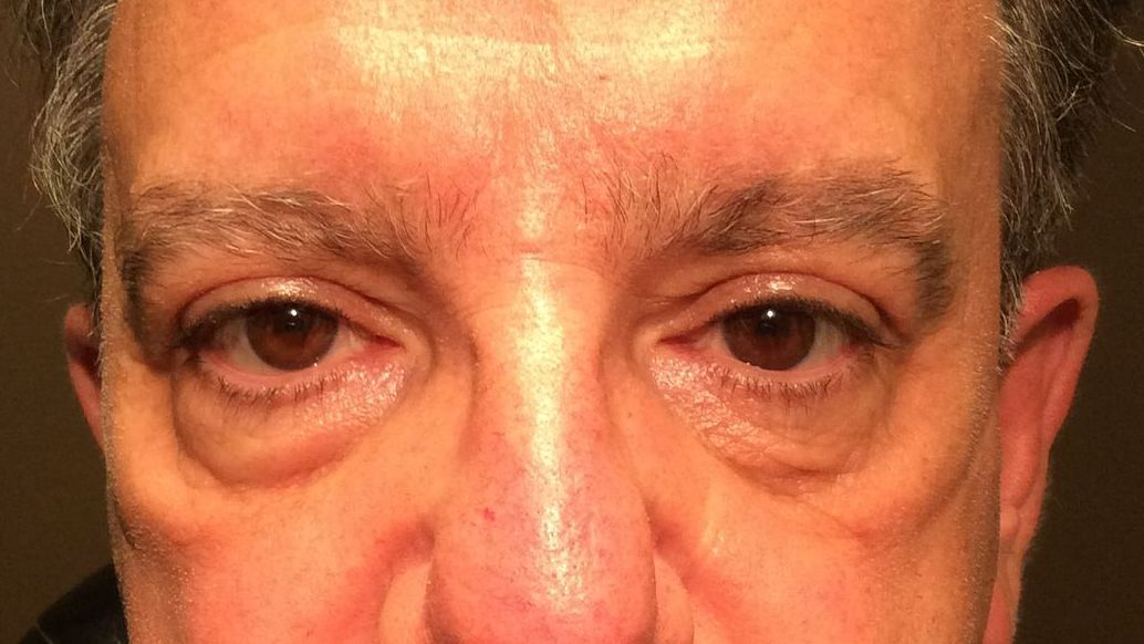 Chirurgie des paupières supérieures