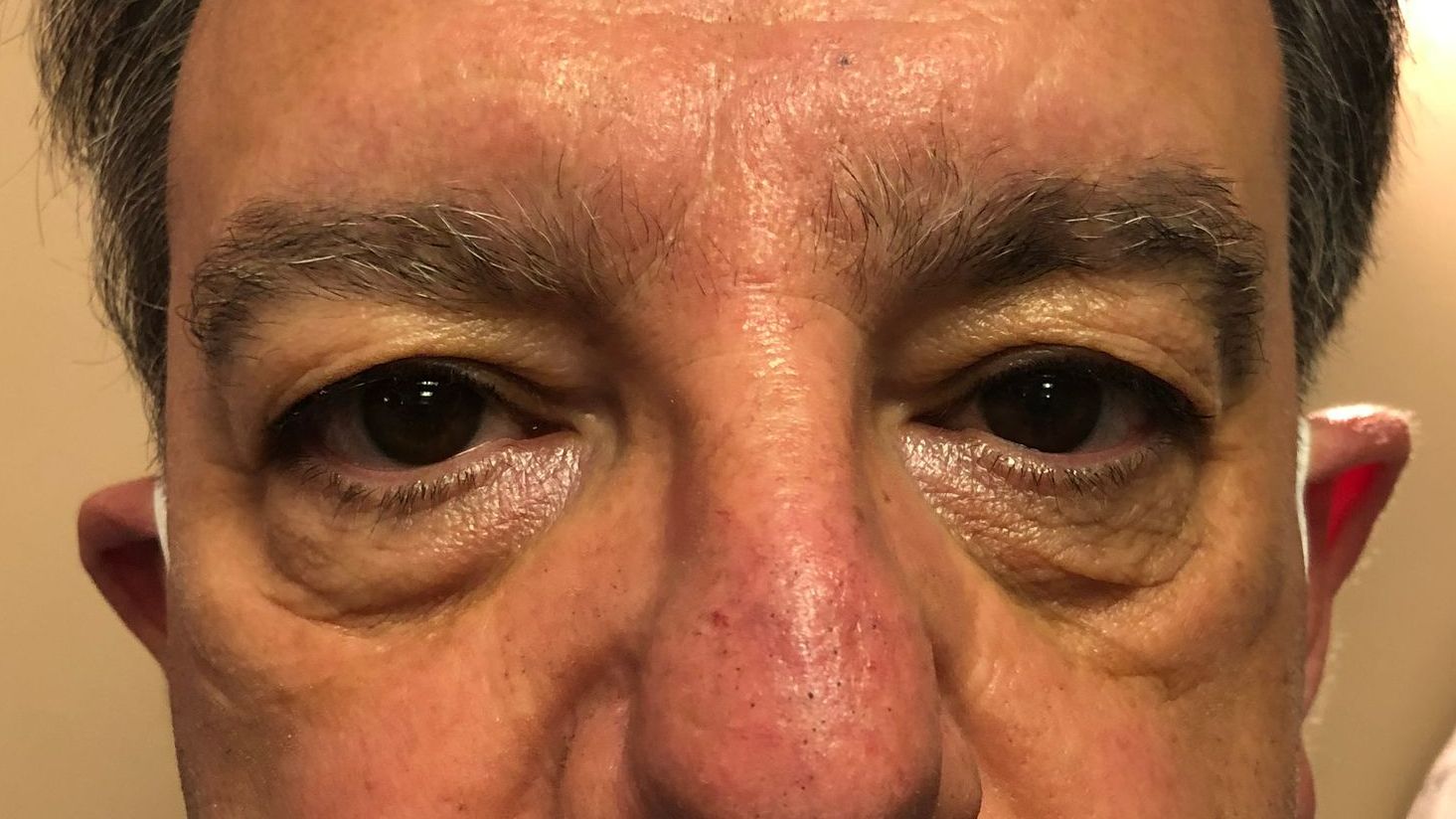 Chirurgie des paupières supérieures