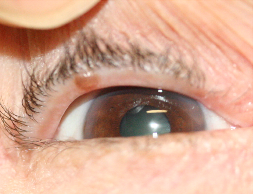 Grains de beauté (Naevus)