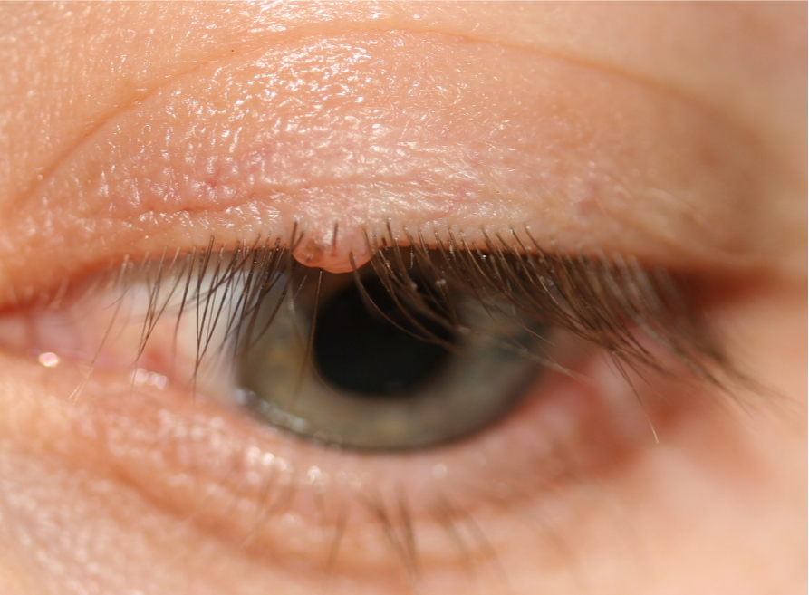 Grains de beauté (Naevus)