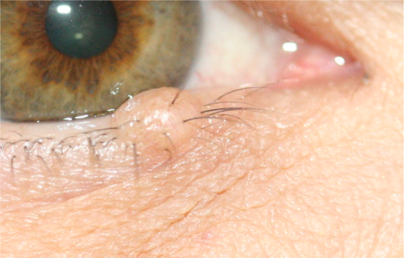 Grains de beauté (Naevus)