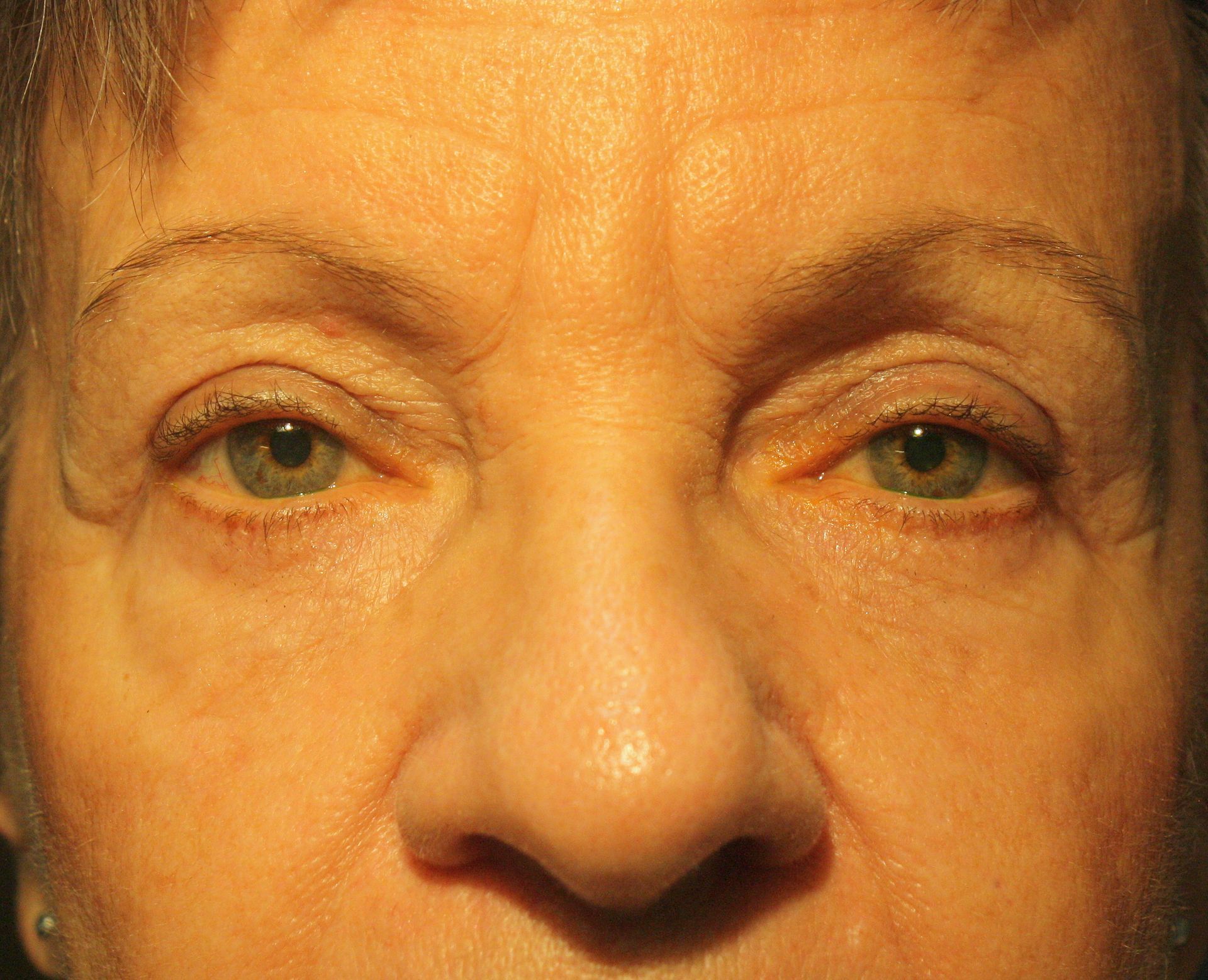 transposition de gras