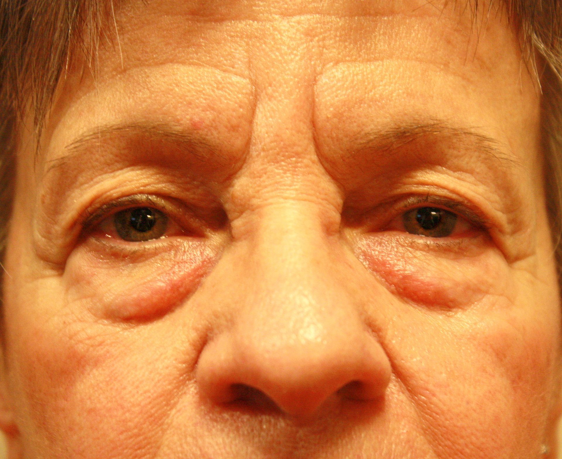 transposition de gras