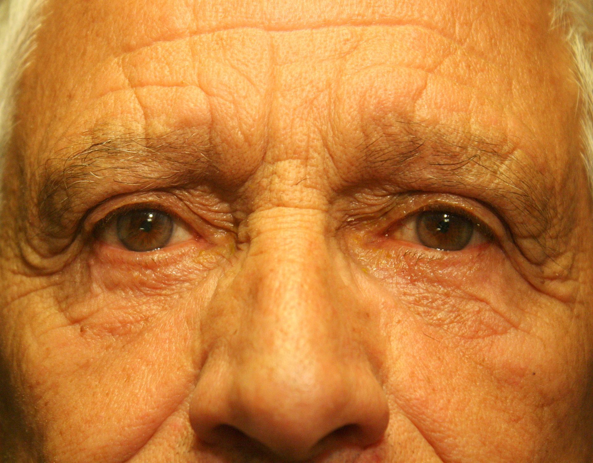 Chirurgie des paupieres inferieures